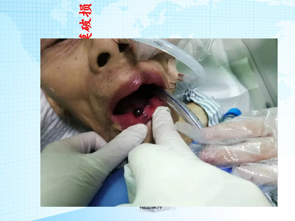 气管插管的固定方法_第2页