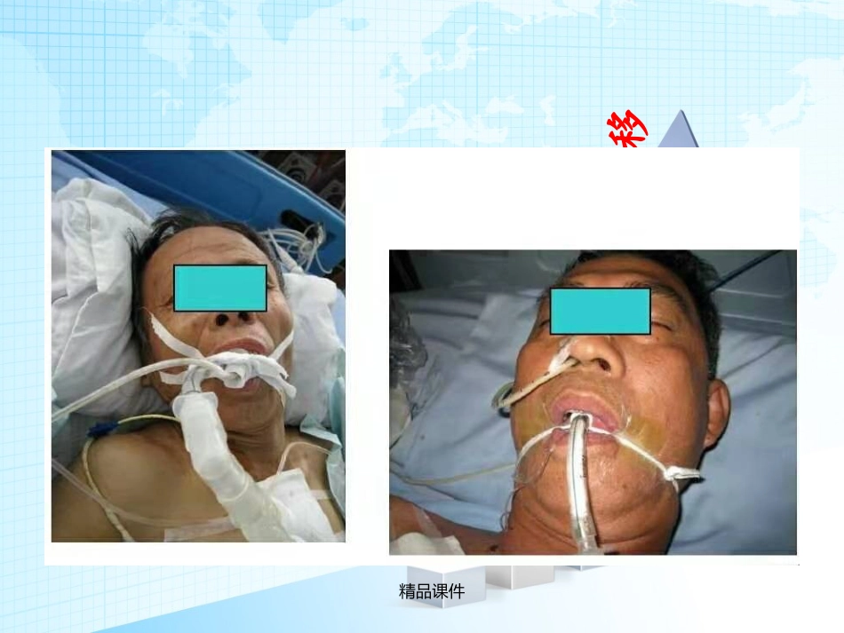 气管插管的固定方法_第3页