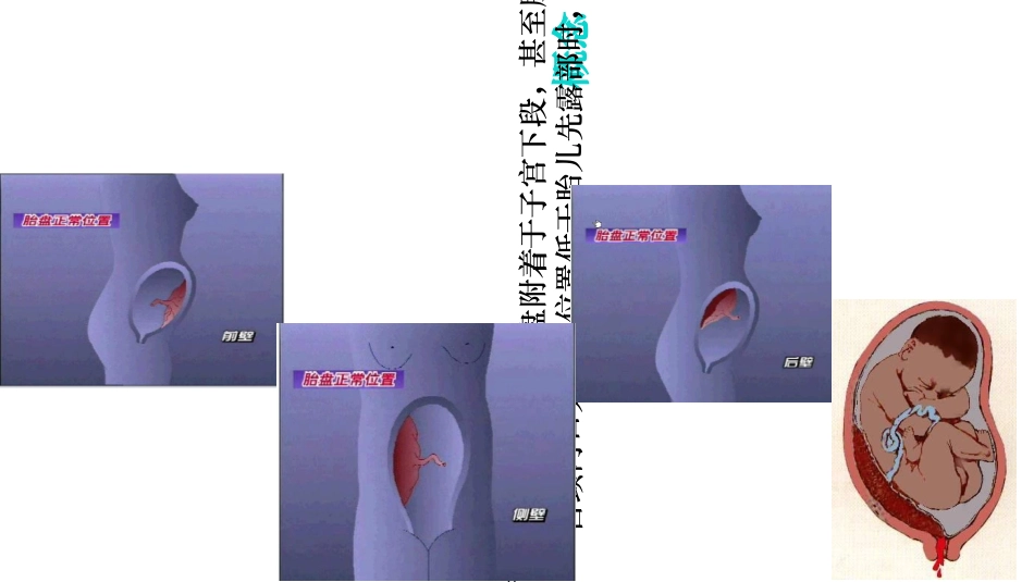 前置胎盘的护理查房课件_第2页