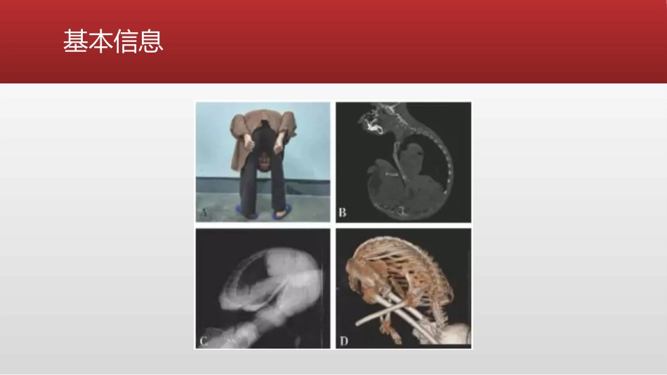 强直性脊柱炎极重度脊柱后凸畸形折叠人的麻醉管理_第3页