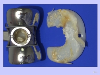 全膝关节置换的翻修