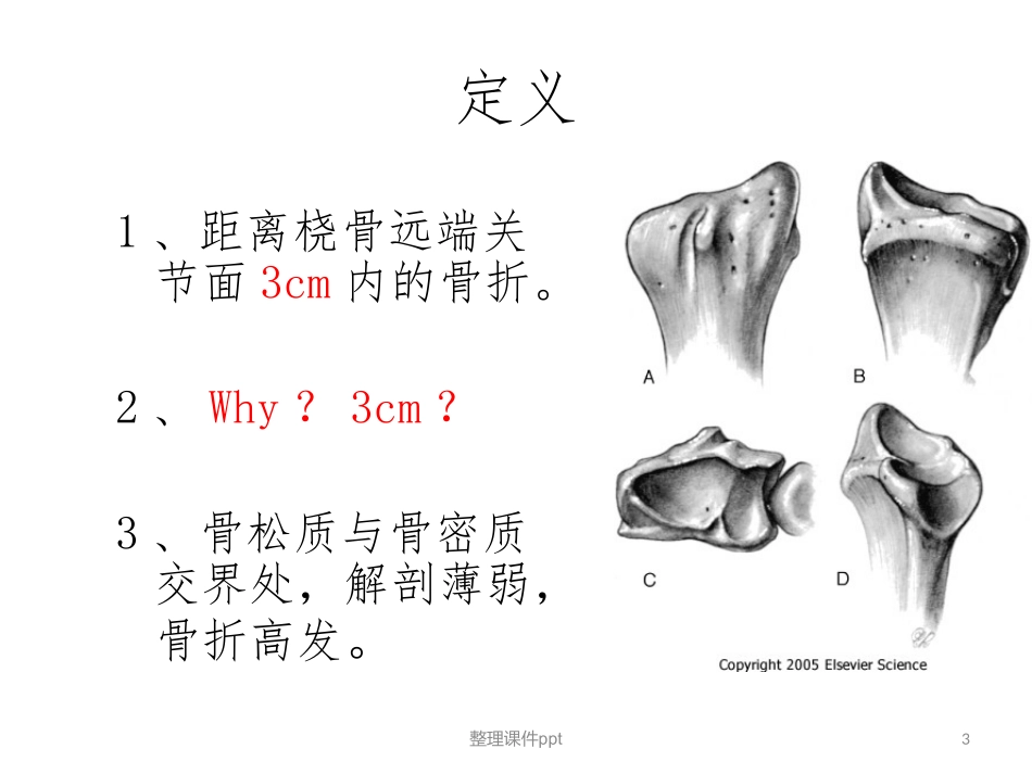 桡骨远端骨折_第3页