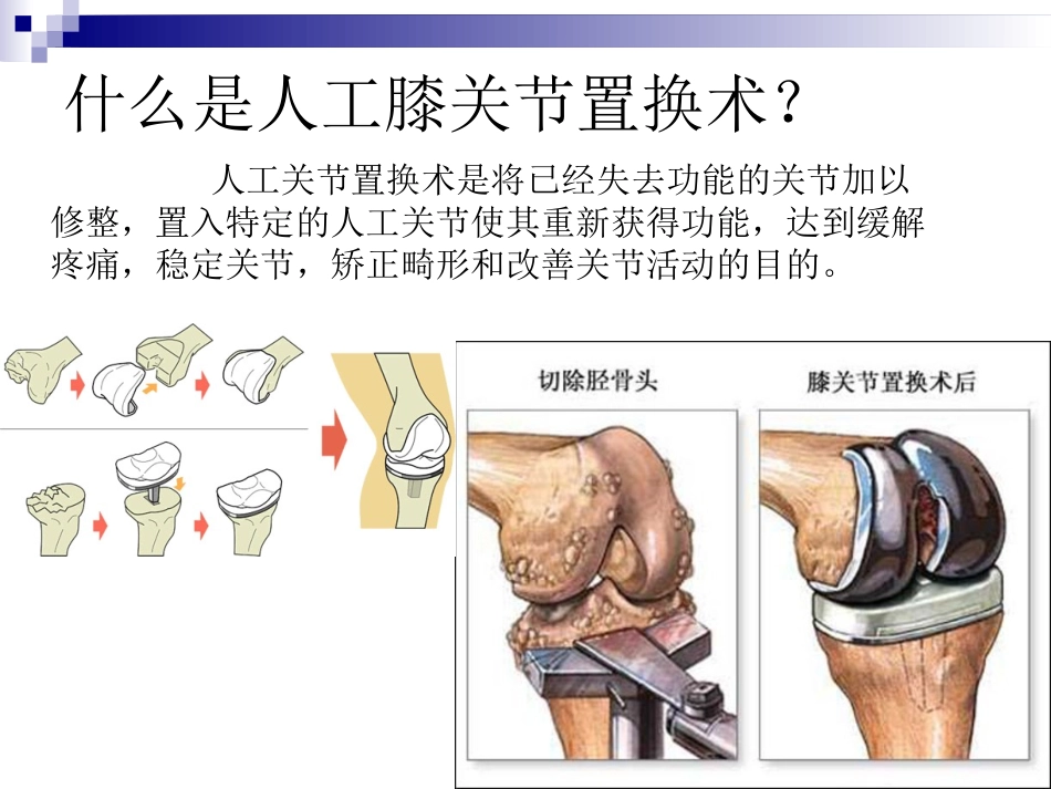 人工膝关节的护理查房_第3页