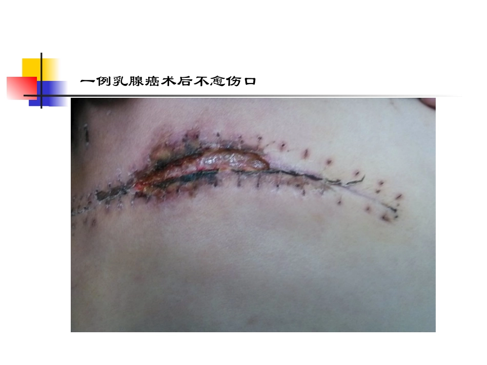 伤口造口案例分析_第2页