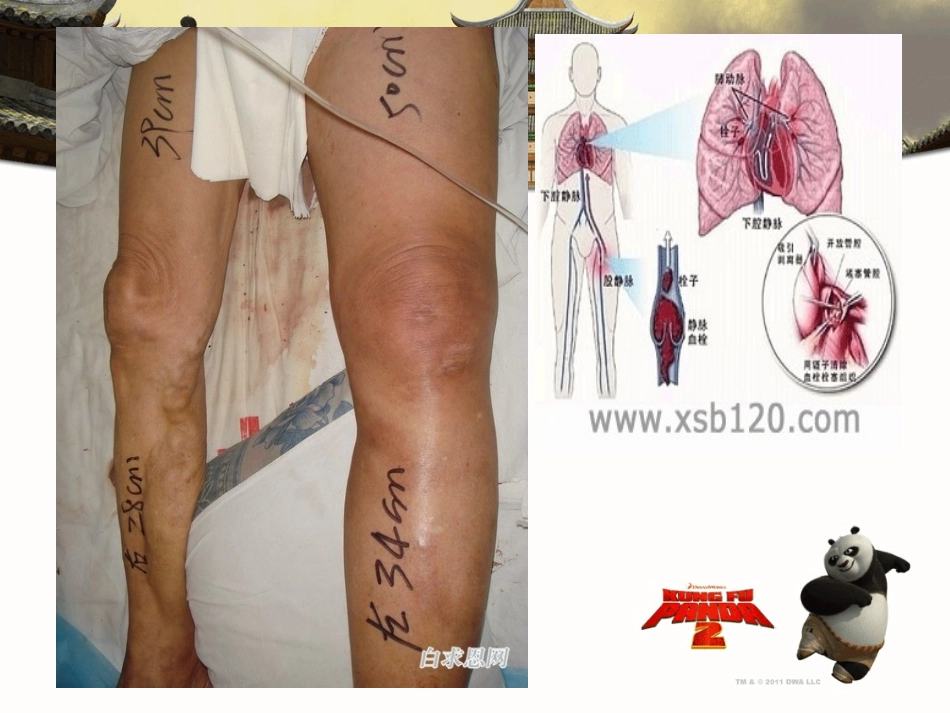 深静脉血栓的预防和护理_第3页