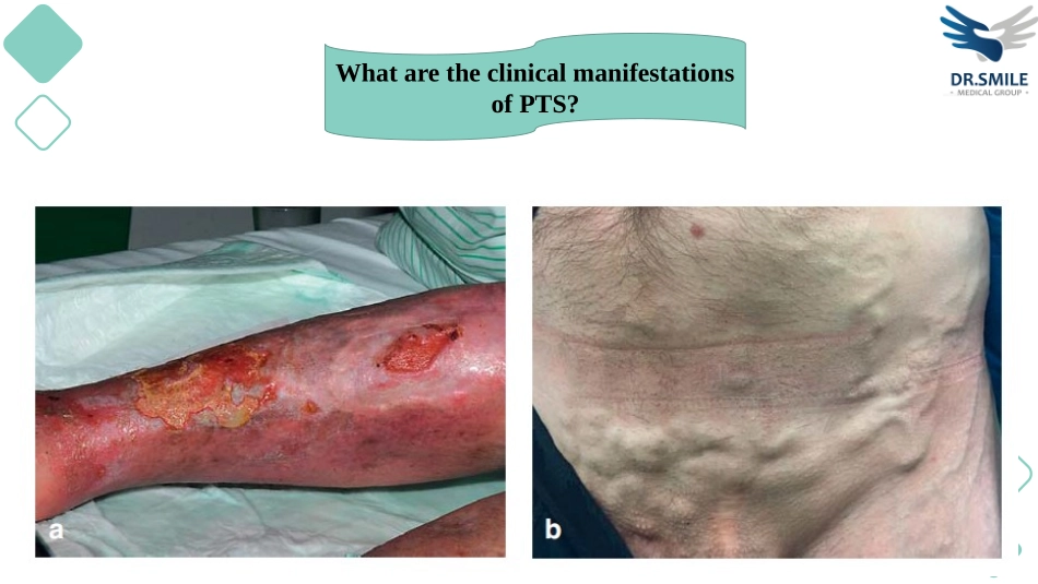 深静脉血栓后综合征的治疗_第3页