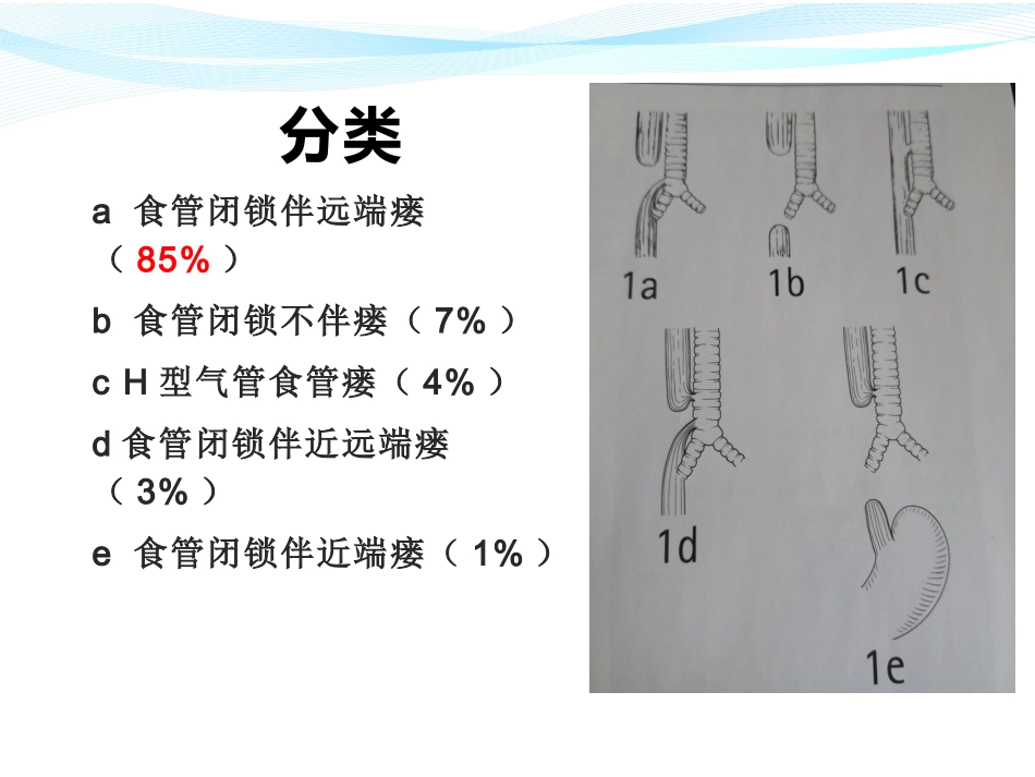 食管闭锁诊疗百度_第3页