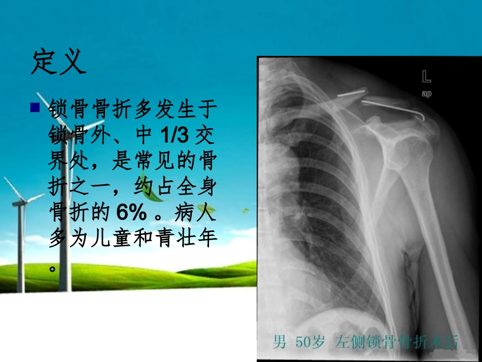 锁骨骨折的护理讲义_第2页