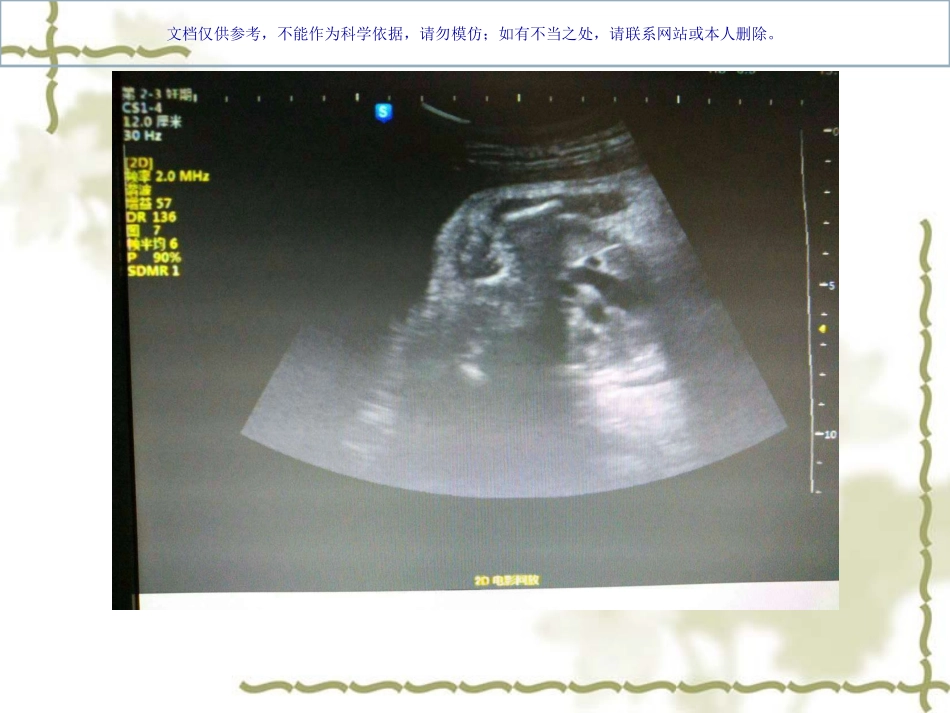 胎儿永存左上腔病例讲座课件_第2页