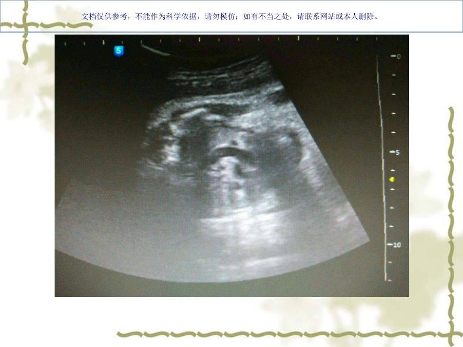 胎儿永存左上腔病例讲座课件_第3页