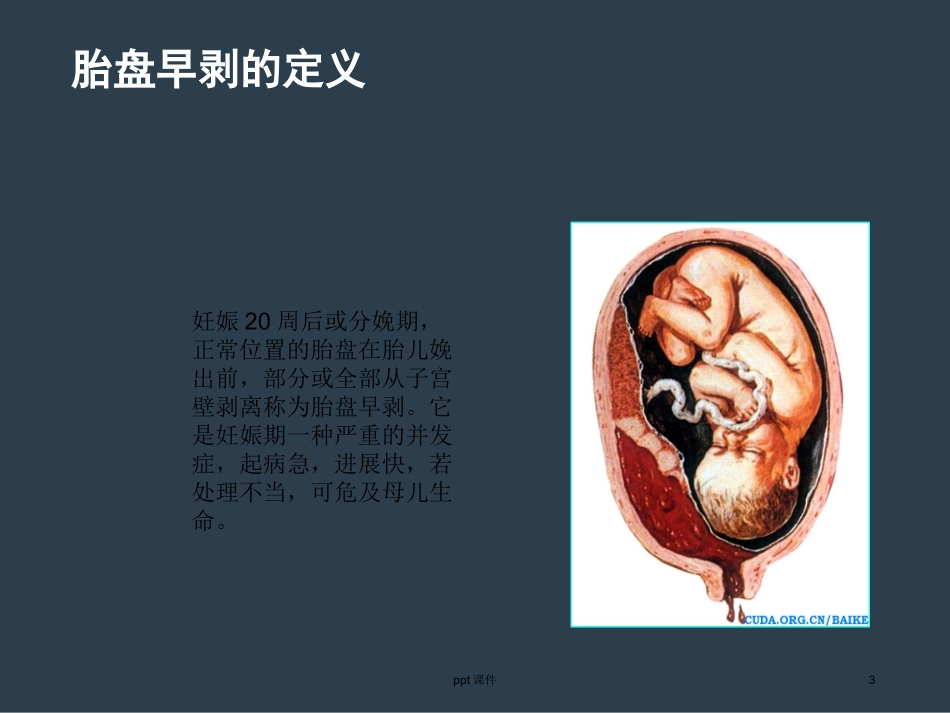 胎盘早剥的护理查房课件_第3页