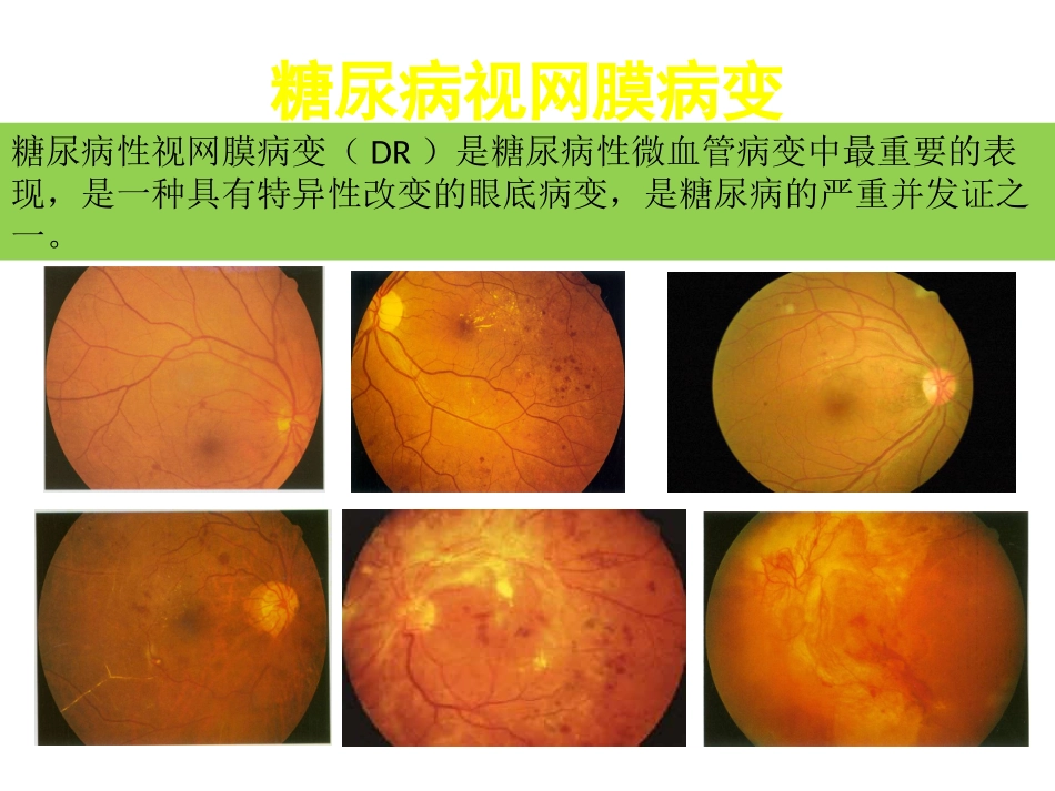 图说糖尿病视网膜病变_第2页