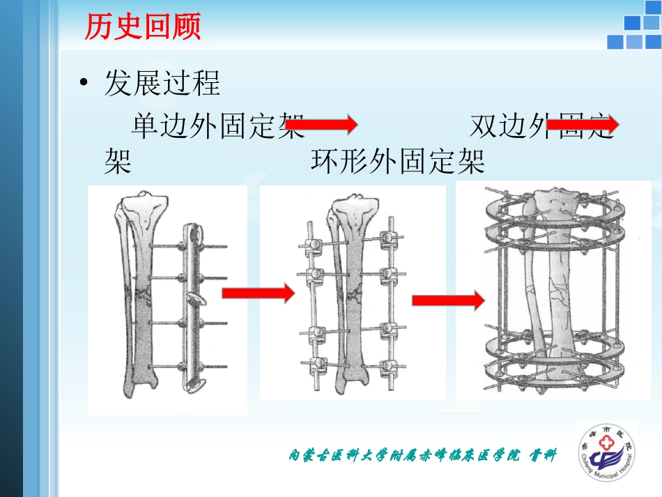 外固定支架的力学原理_第3页