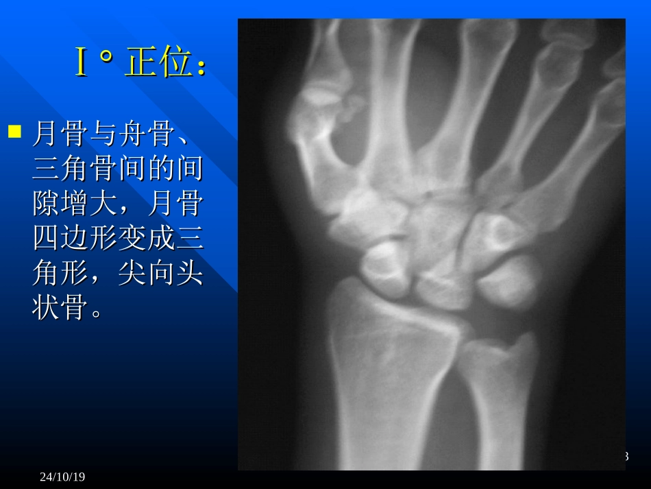 腕关节月骨脱位_第3页