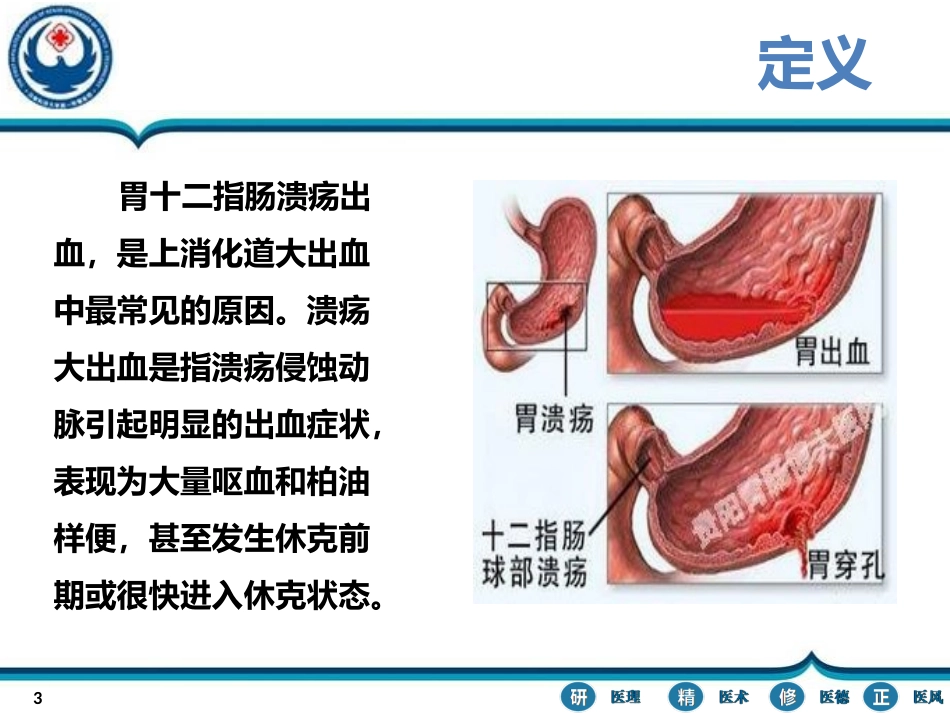 胃十二指肠溃疡大出血_第3页