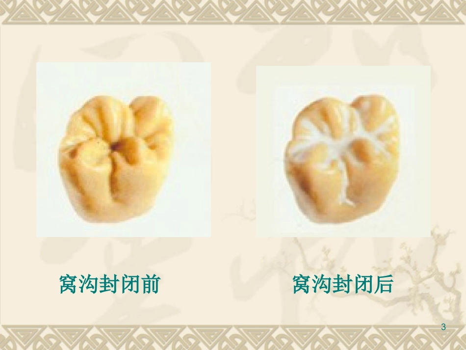 窝沟封闭步骤_第3页
