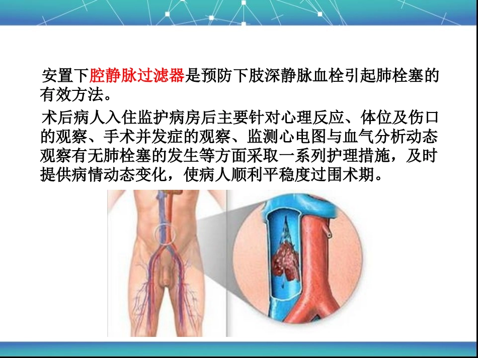 下腔静脉滤器植入术后护理_第3页