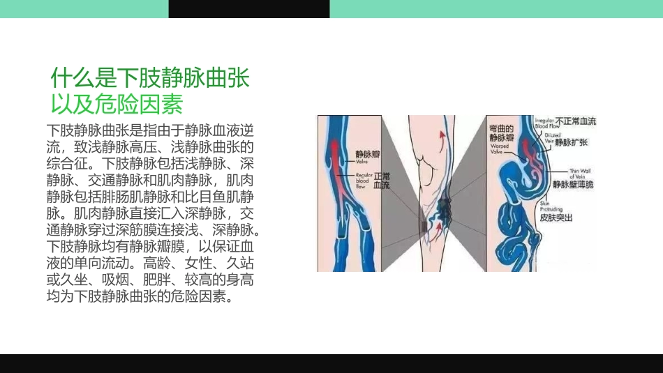 下肢静脉曲张的治疗现状和展望_第2页
