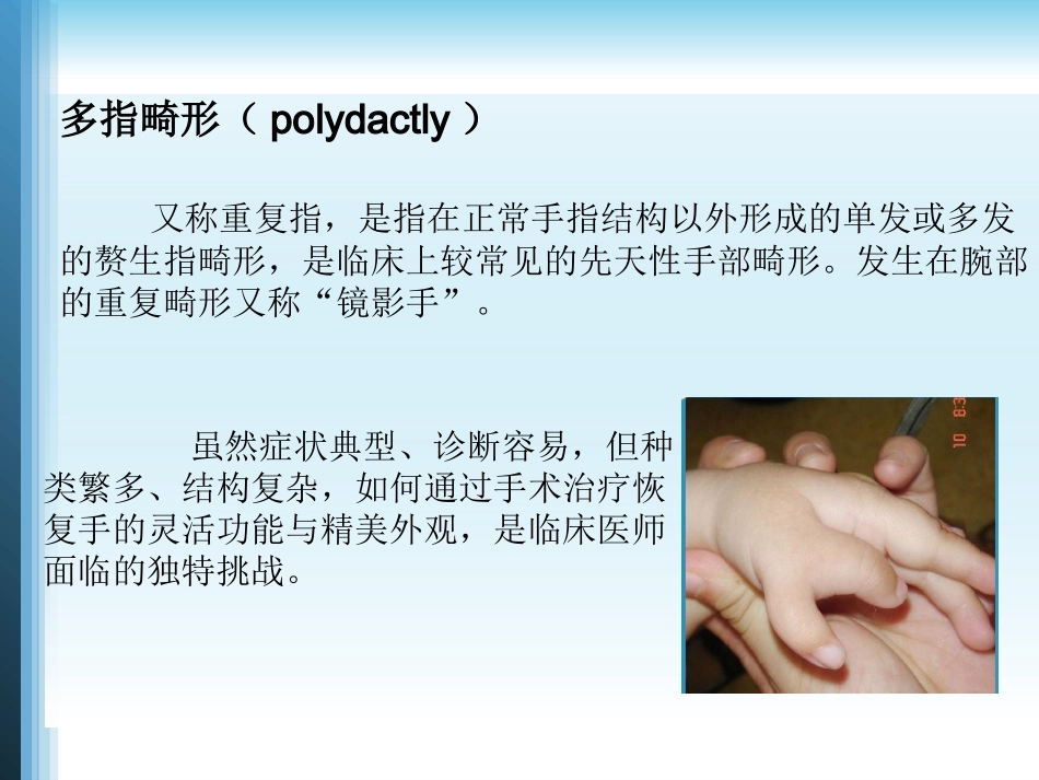 先天性多指畸形分型及诊治_第2页