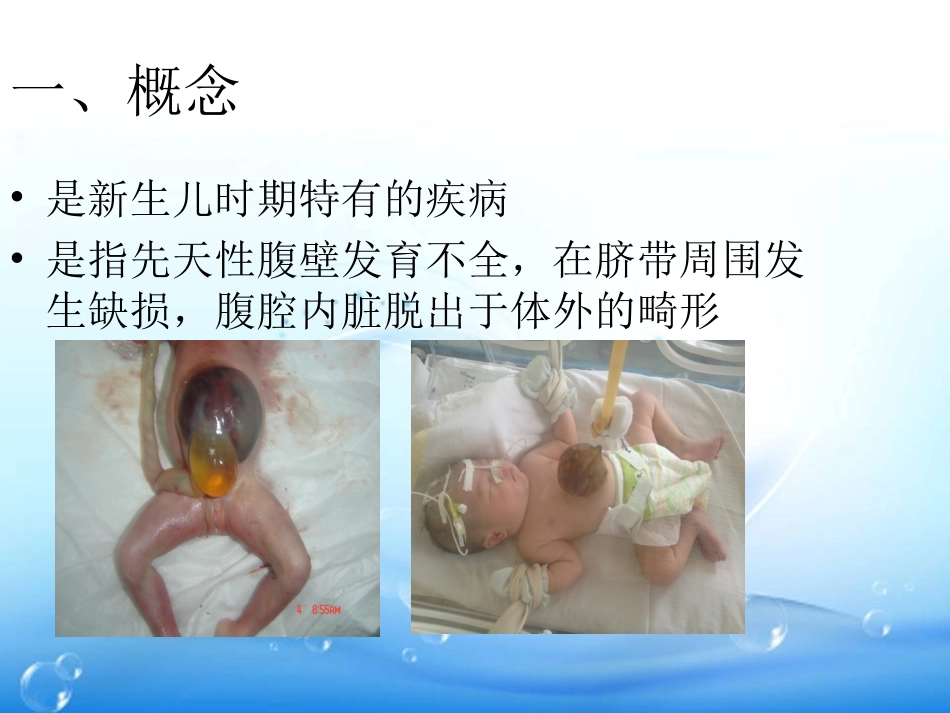先天性脐膨出_第3页