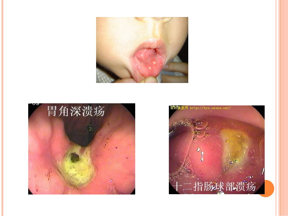 消化性溃疡科普_第3页