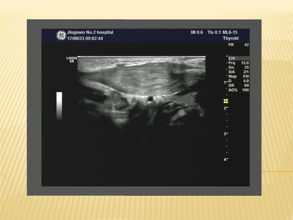 小儿斜颈超声诊疗_第3页