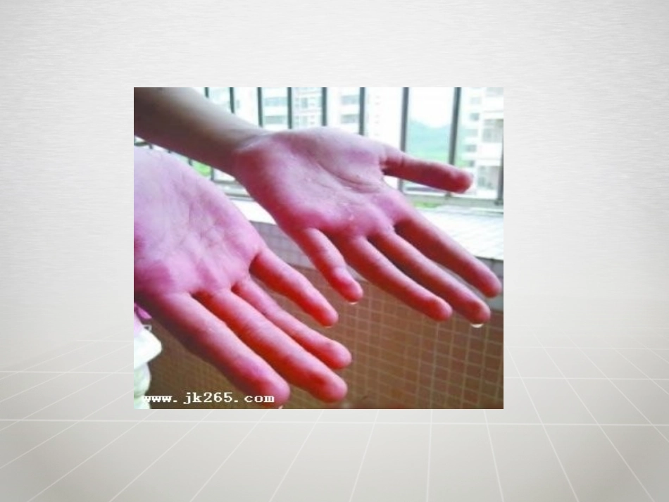 胸腔镜下交感神经切除术后护理介绍_第2页