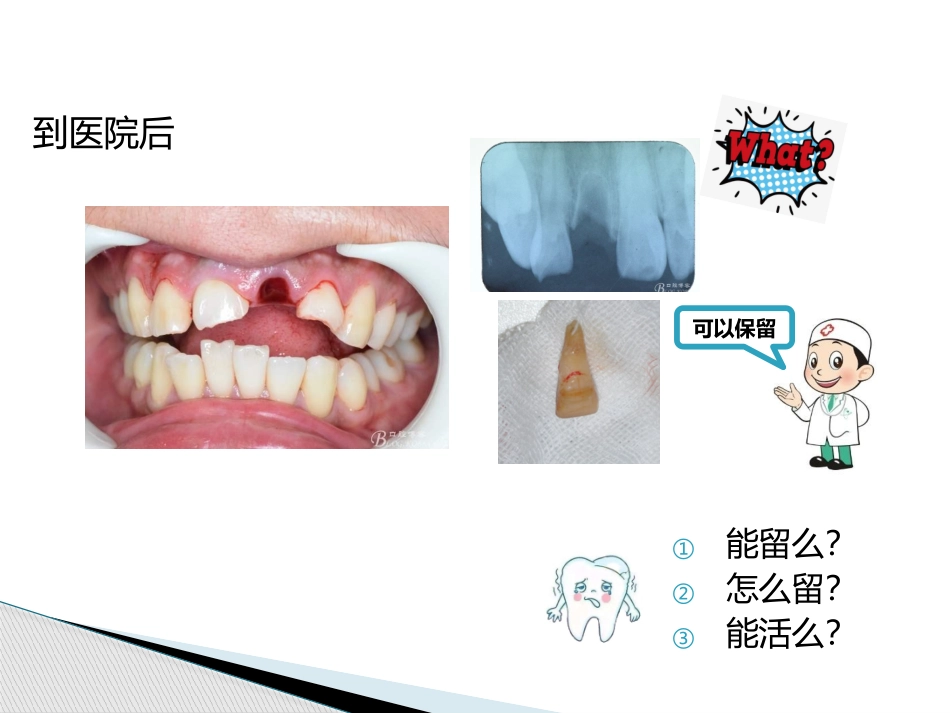 牙外伤之牙脱位_第3页