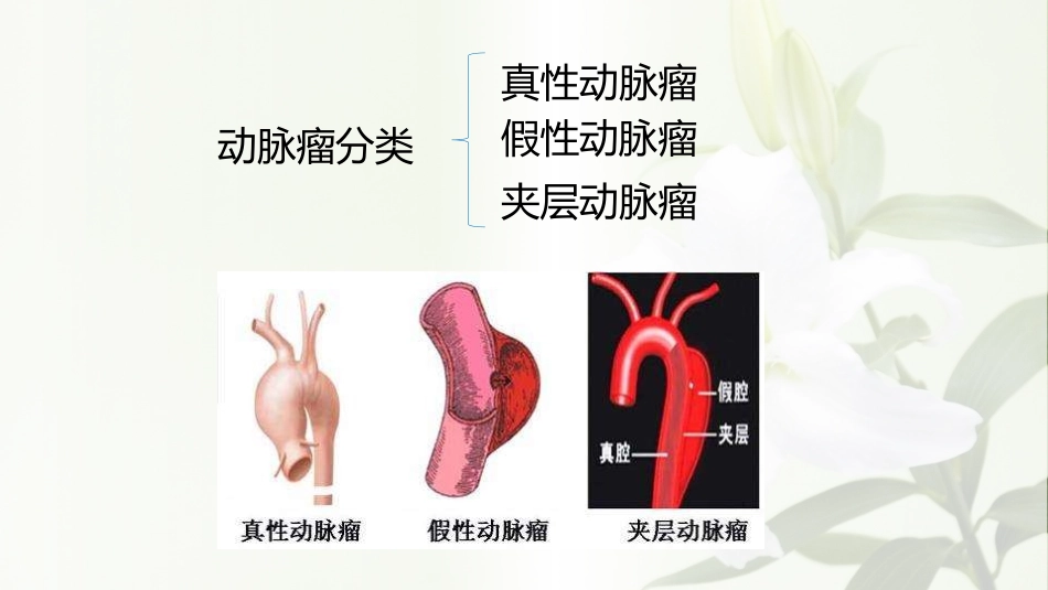 杨道玲动脉瘤的超声表现_第2页