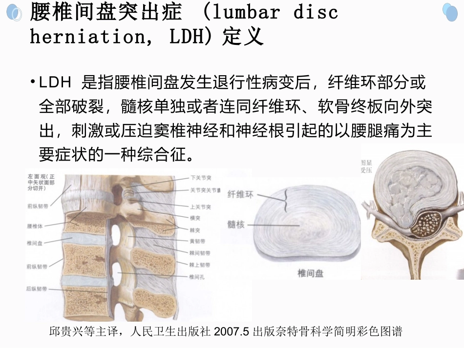 腰椎间盘突出症的康复_第3页