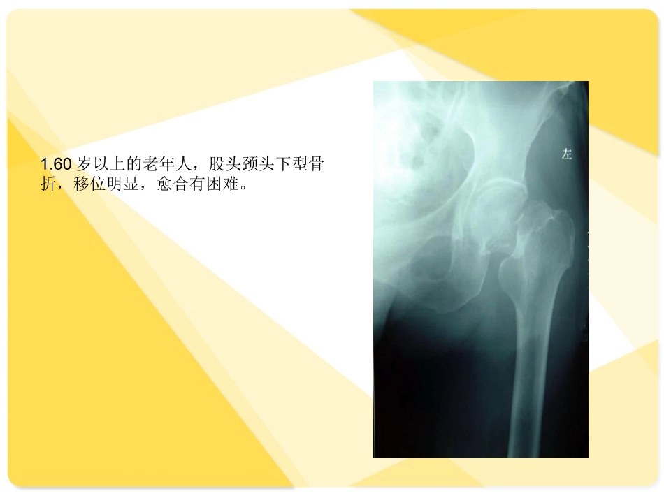 医学课件详解人工股骨头置换术_第2页