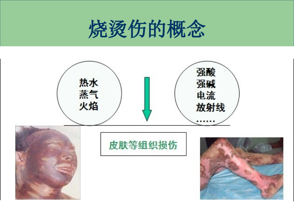 医学烧烫伤现场急救处理专题培训课件_第2页