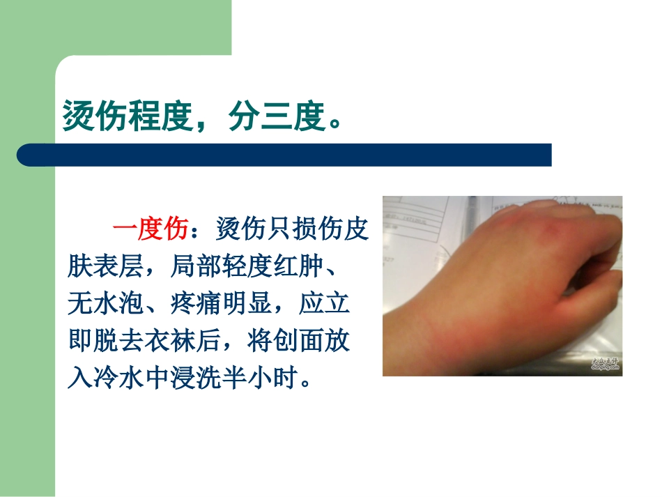 医学烫伤急救和护理课件_第2页