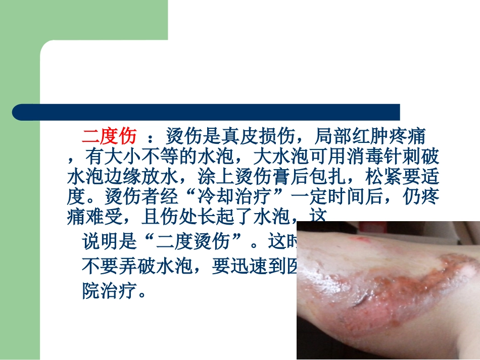 医学烫伤急救和护理课件_第3页