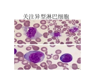 异常淋巴细胞形态