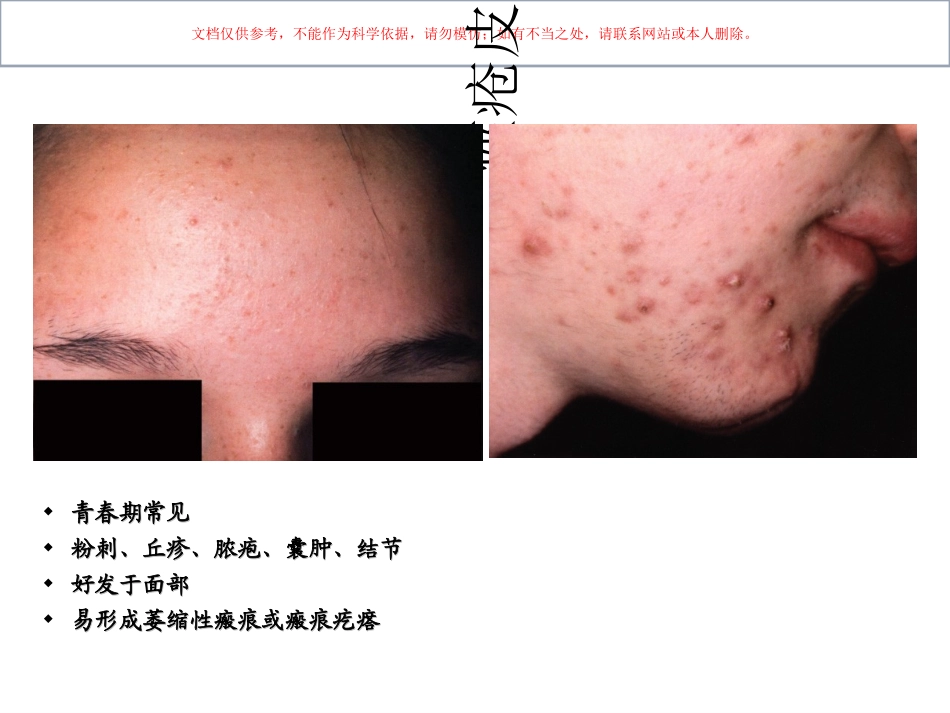 油性皮肤和痤疮课件_第2页