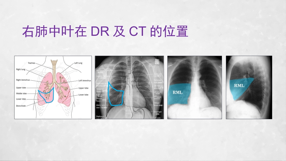 右肺中叶综合征_第3页