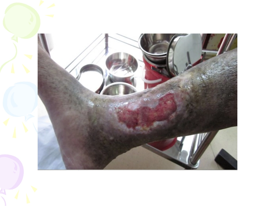 右下肢静脉溃疡的个案护理-医学课件_第1页