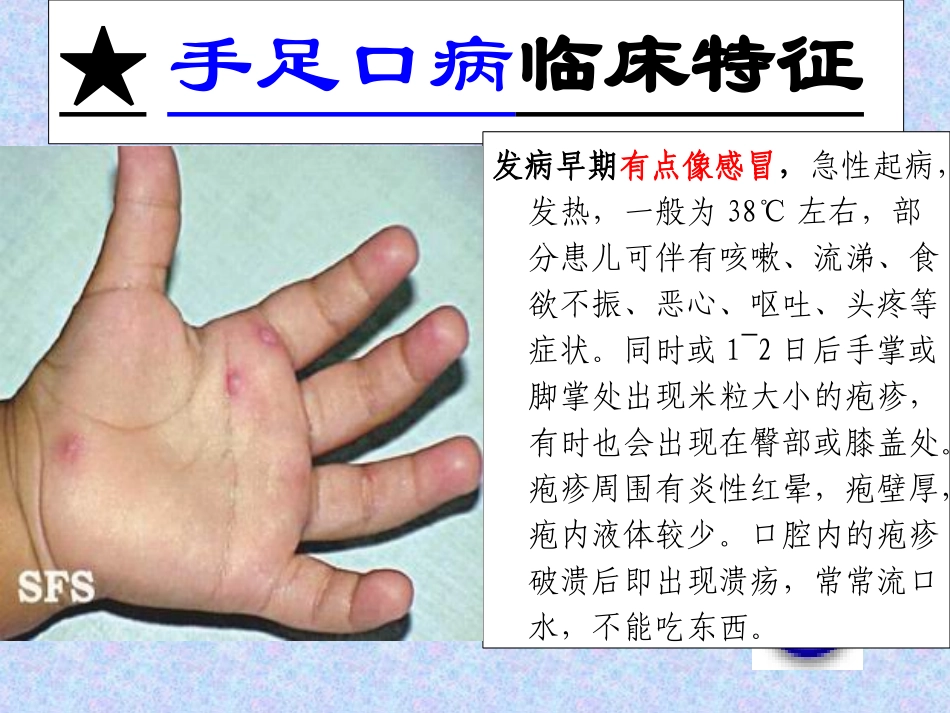 预防手足口病主题班会_第3页