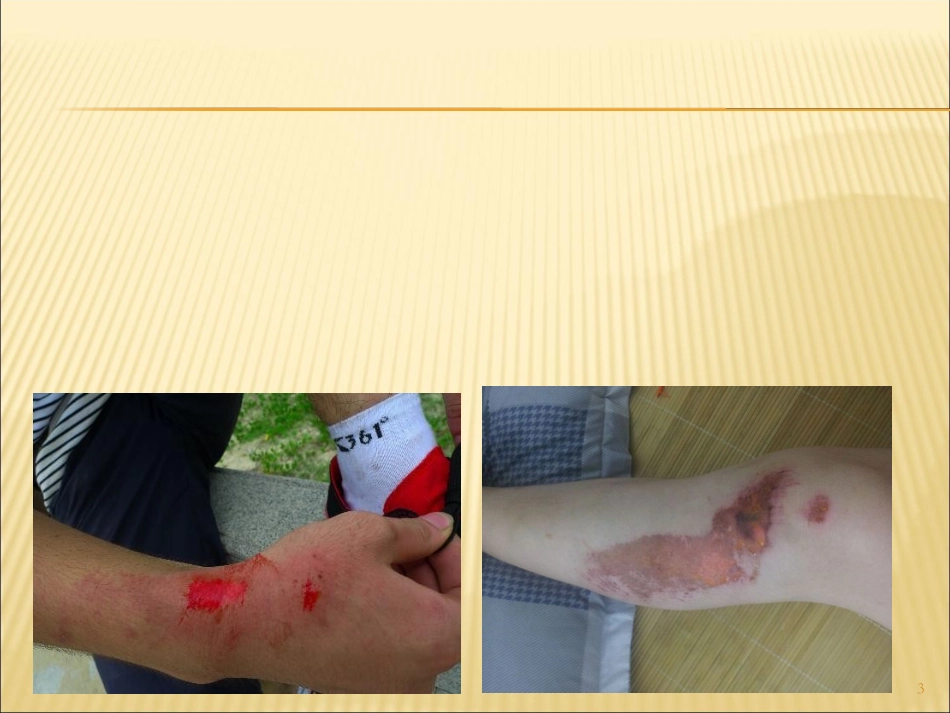 常见外伤处理方法_第3页