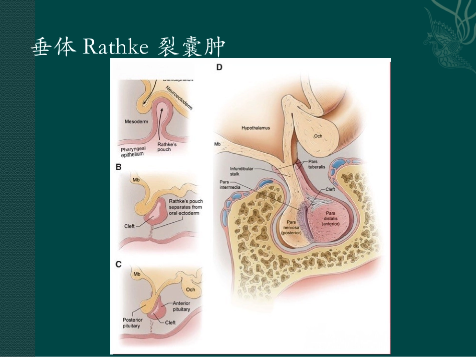 垂体Rathke裂囊肿_第3页