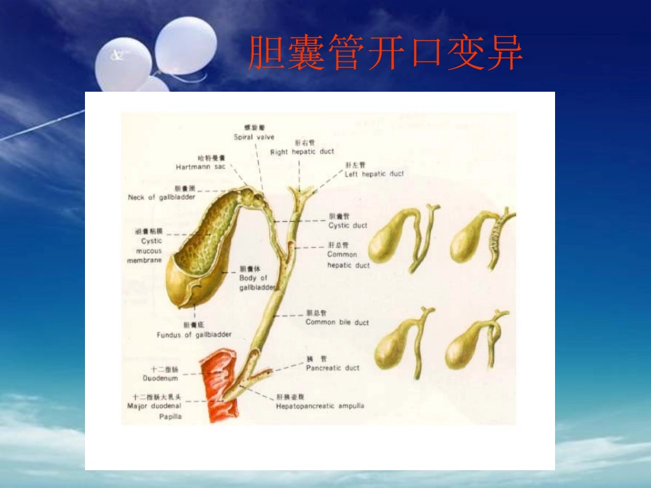 胆囊结石伴胆囊炎培训课件_第3页