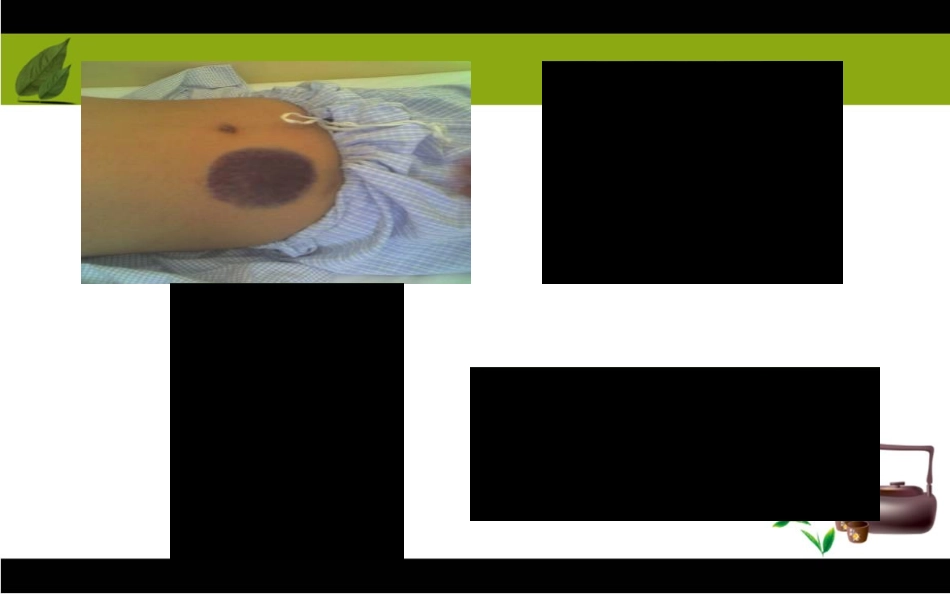 低分子肝素的使用及注意事项_第1页