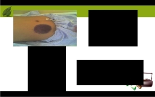 低分子肝素的使用及注意事项