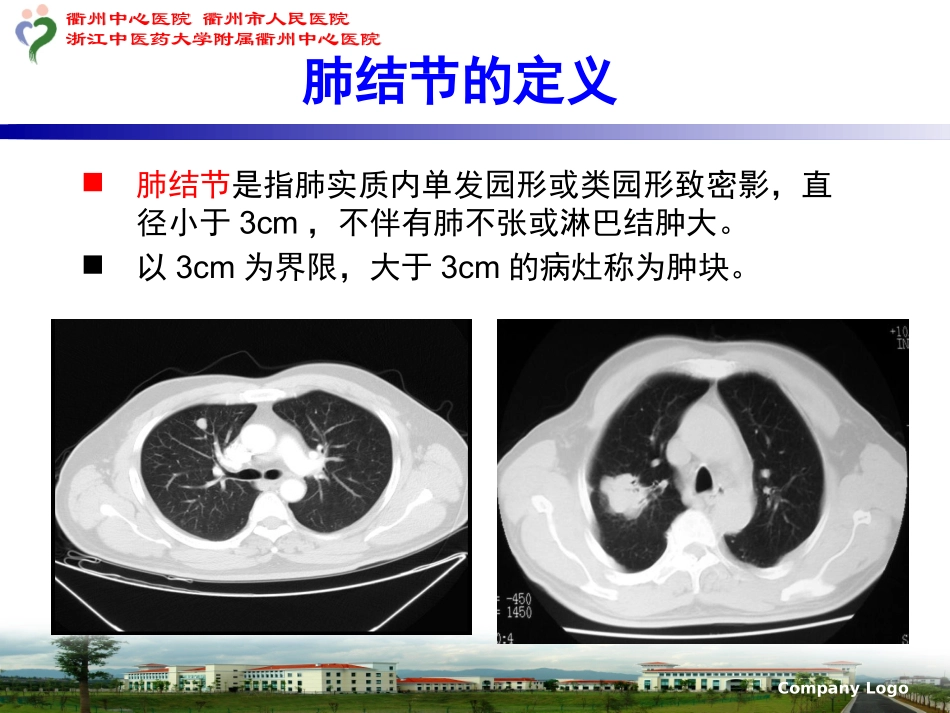 低剂量螺旋CT检测肺结节_第2页