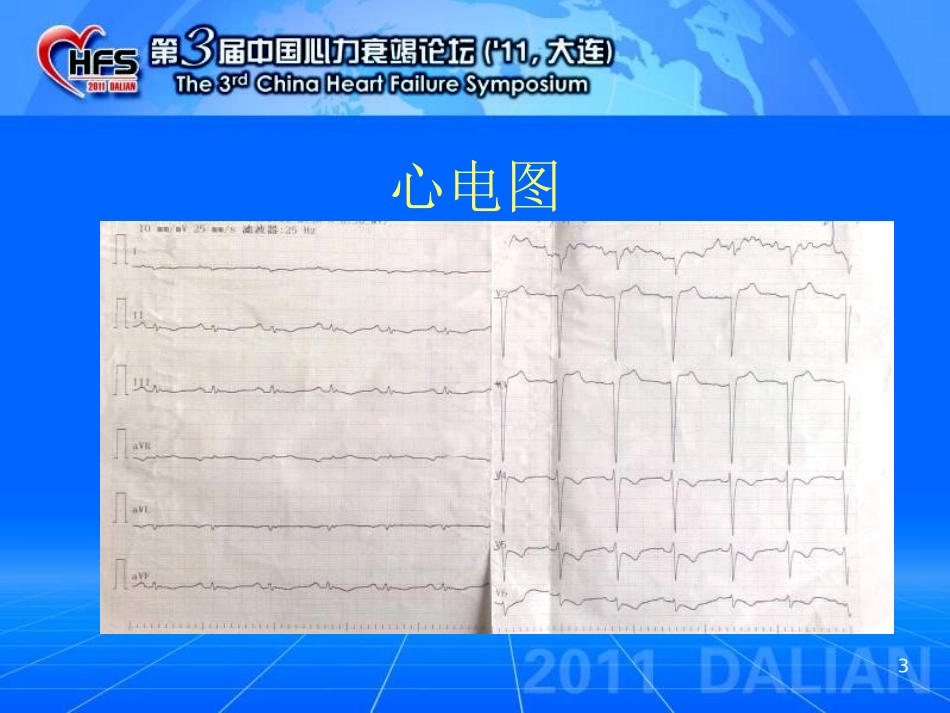 淀粉样变性心肌病一例_第3页