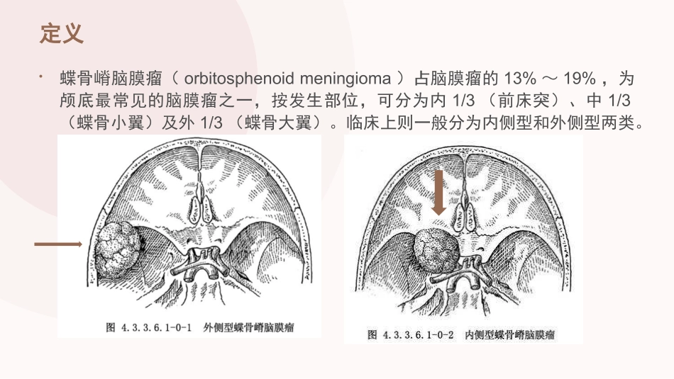 蝶骨嵴脑膜瘤自动保存_第2页
