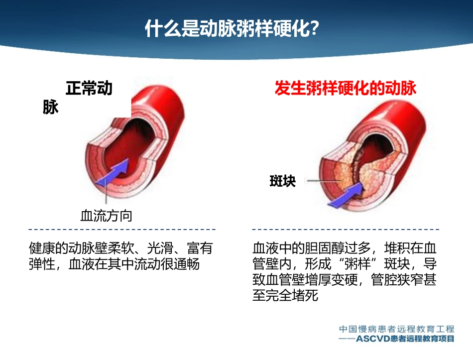 动脉粥样硬化会导致哪些疾病_第2页