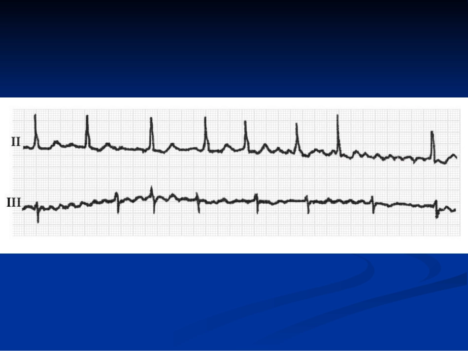 房颤的心电图诊疗优质课件_第3页