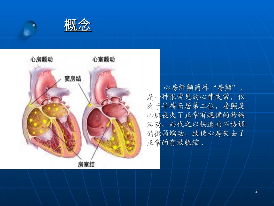 房颤及左心耳封堵课件_第2页